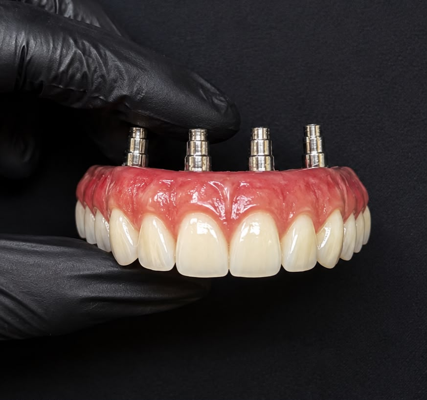 Prótese protocolo sobre implantes